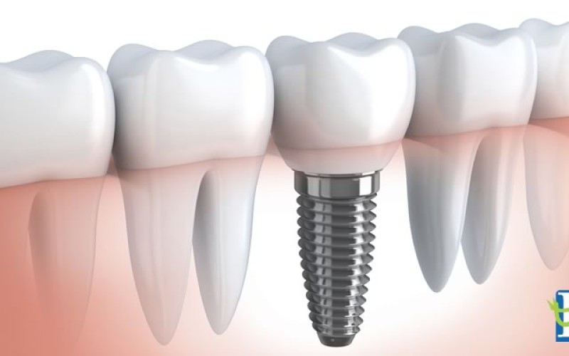 centro-odontologico-r8-implante-dentario3-800x500