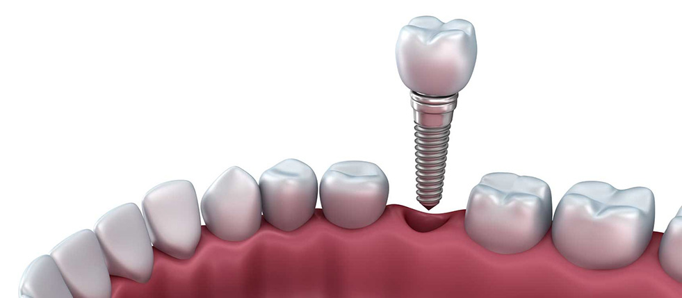 implantes-dentarios2