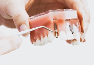 implantes_dentarios